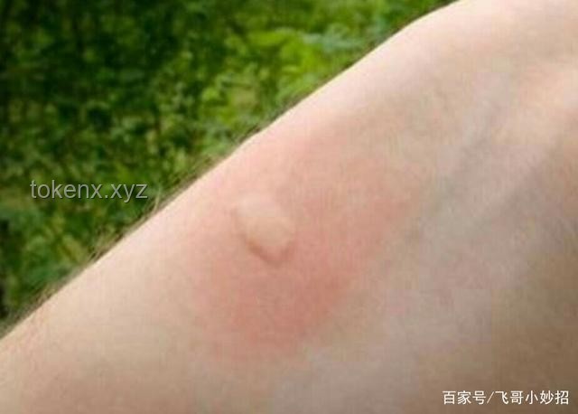 **被蚊子咬了？这4个迅速止痒的妙招，真心希望你永远用不上！**
